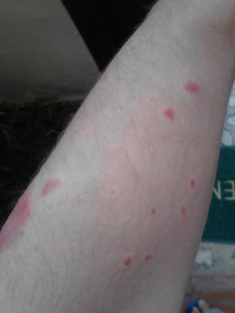psoriasis plaques on arms