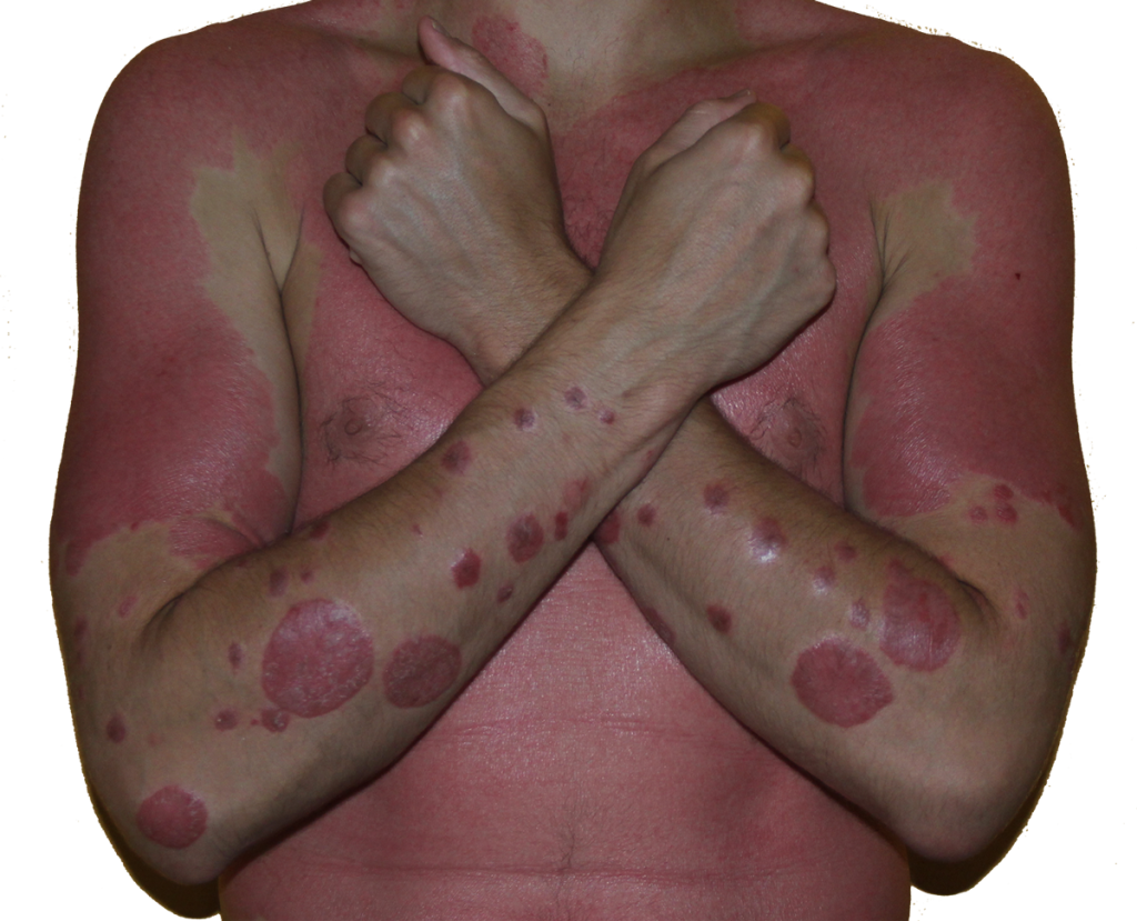 guttate psoriasis home remedy