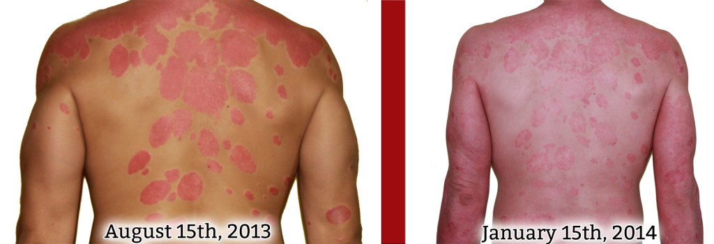 back psoriasis healing comparison picture