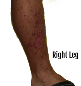 leg psoriasis healing