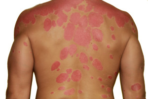 get rid of Psoriasis!