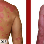 back psoriasis healing comparison picture