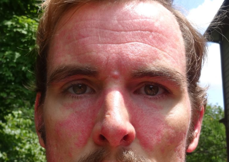 curepsoriasisnaturallyface A Warrior Curing Psoriasis Naturally