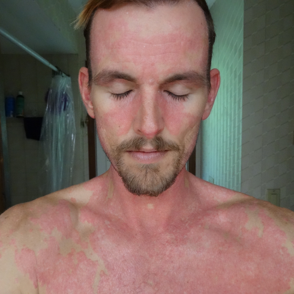 curepsoriasisnaturallyDSC04172 A Warrior Curing Psoriasis Naturally